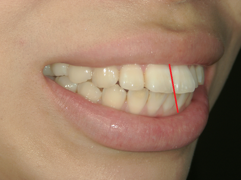 before Ceramic crown teeth straightening examples for overbite