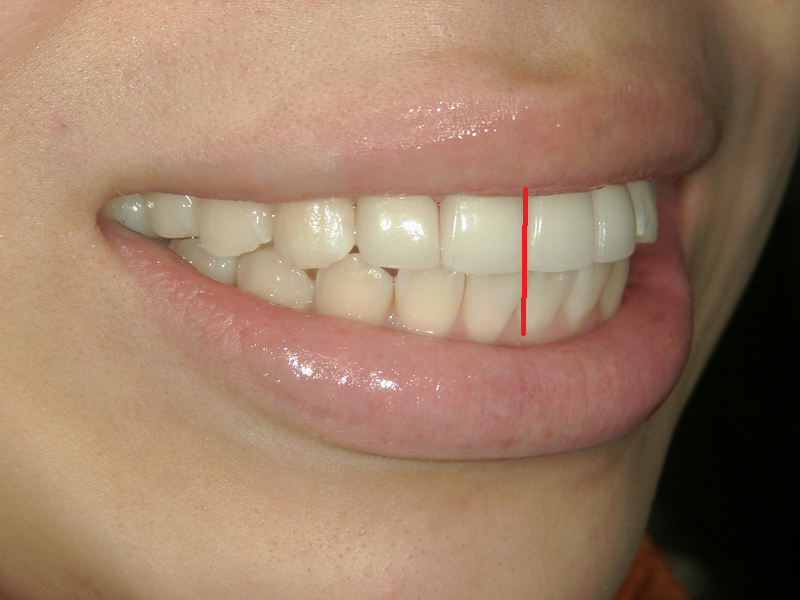 after Ceramic crown teeth straightening examples for overbite