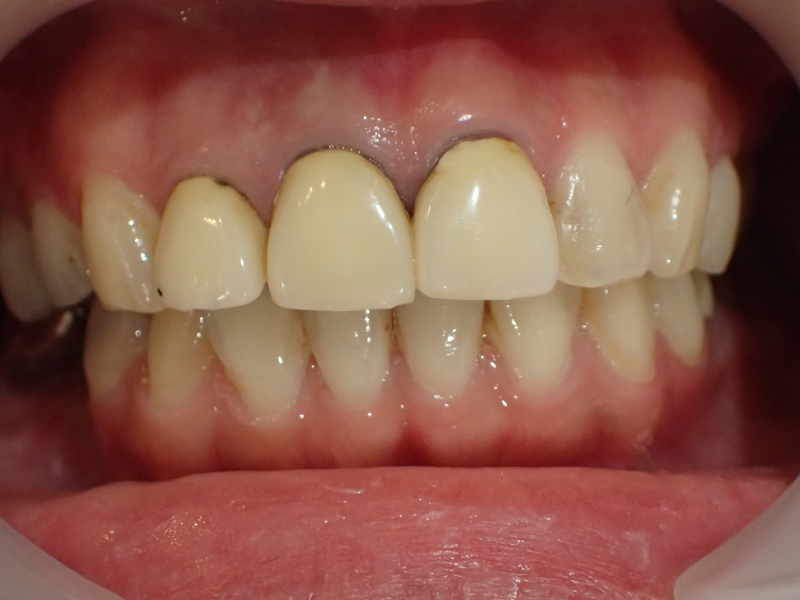 before retreatment examples with ceramic crowns for old dental crowns