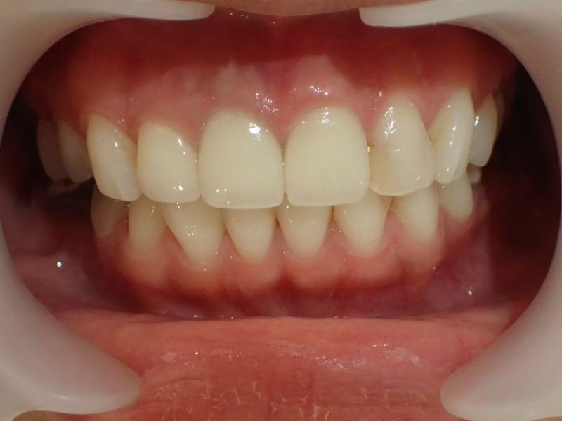 after retreatment examples with ceramic crowns for old dental crowns