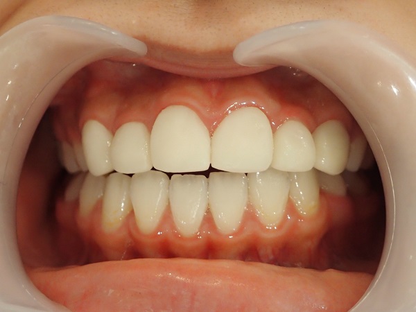 Simulation with Temporary Teeth