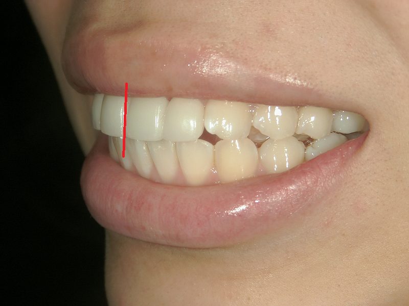 after cosmetic dentistry