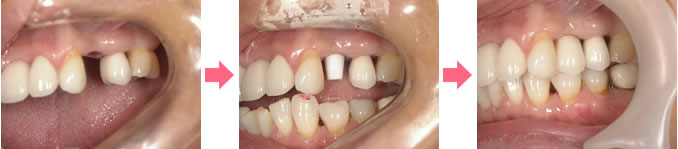 our Implant treatment