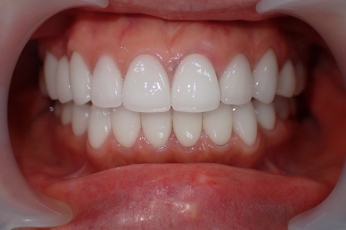 after ceramic crown teeth straightening examples