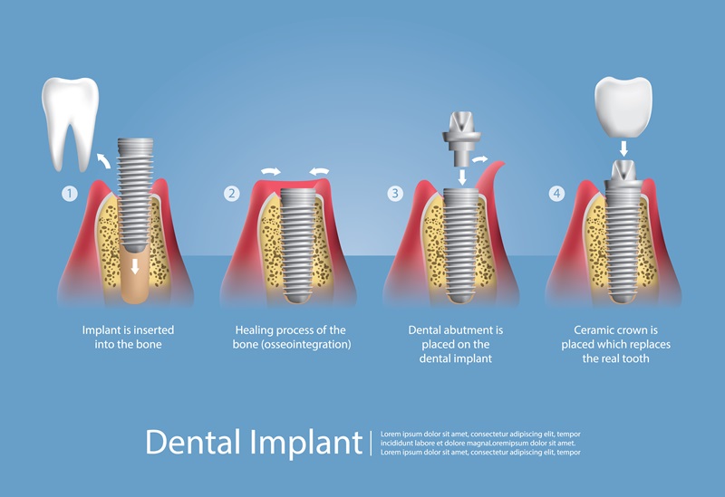 Dental Implants