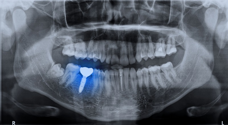 CT scanners