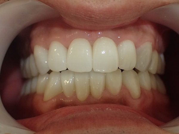 after the following case photos present the transformations achieved through ceramic crowns for tetracycline teeth