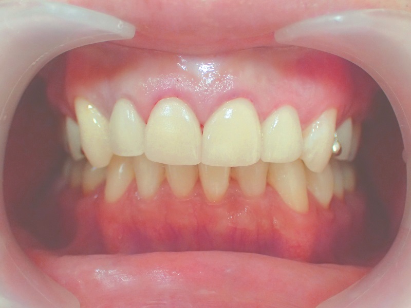 after Ceramic Orthodontics + Gingival(gum) Contouring for Gummy Smile Correction