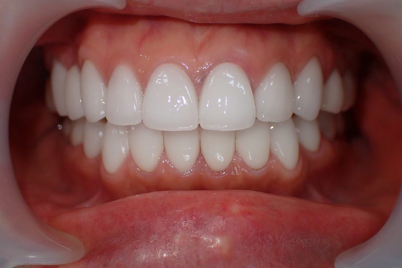 after the following case photos present the transformations achieved through ceramic crowns for tetracycline teeth