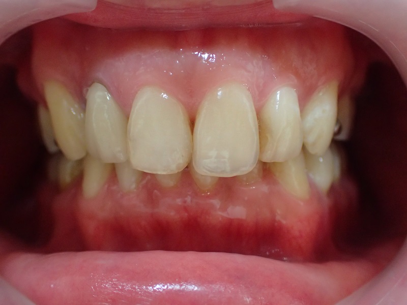 before Ceramic Orthodontics + Gingival(gum) Contouring for Gummy Smile Correction