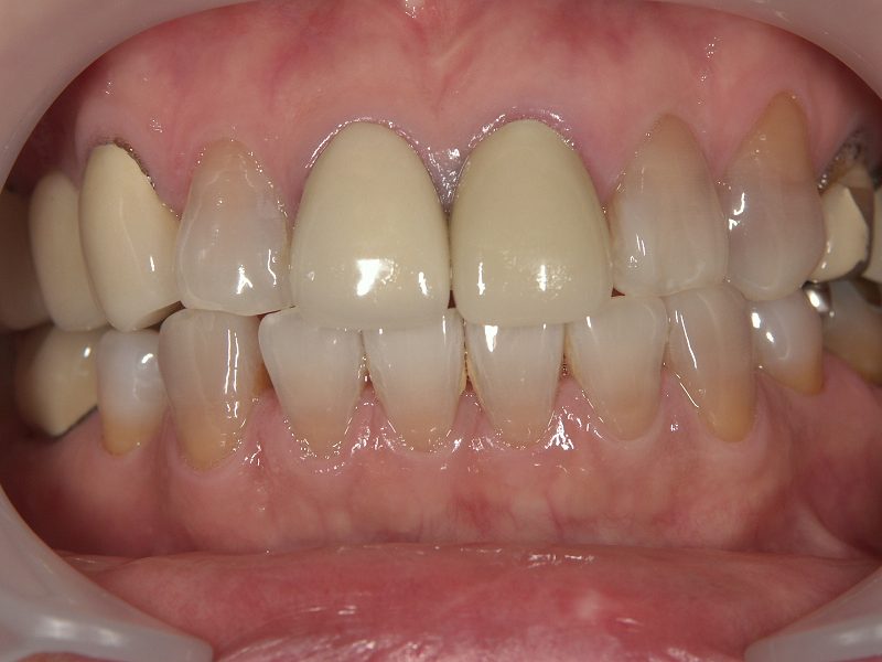 before the following case photos present the transformations achieved through ceramic crowns for tetracycline teeth