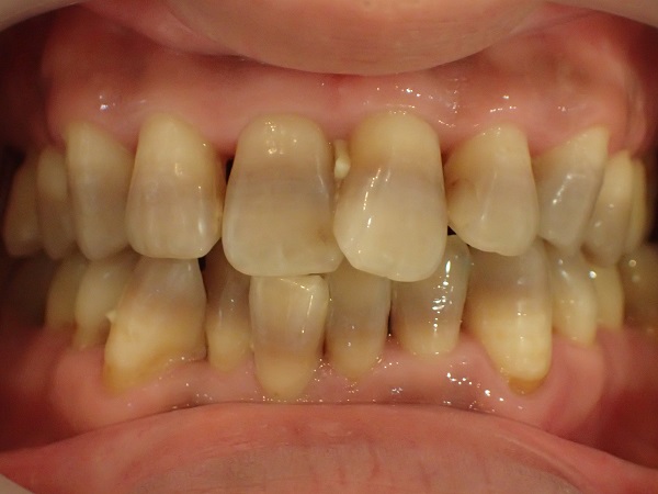 before the following case photos present the transformations achieved through ceramic crowns for tetracycline teeth