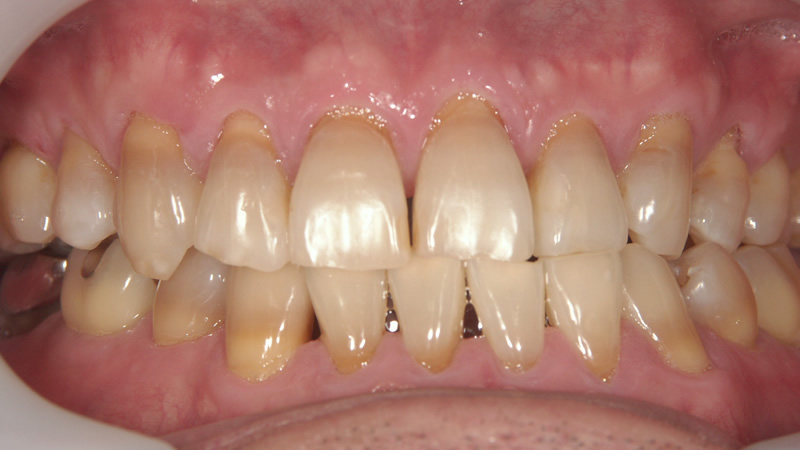 Tetracycline teeth