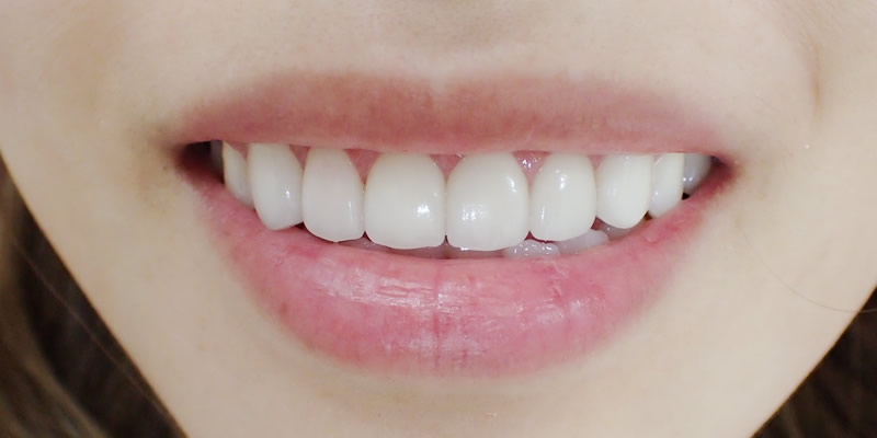 after Ceramic Orthodontics + Gingival(gum) Contouring for Gummy Smile Correction