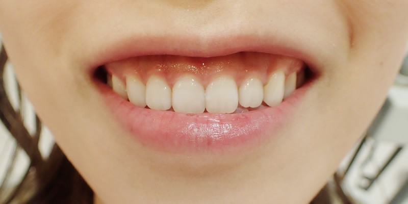 before Ceramic Orthodontics + Gingival(gum) Contouring for Gummy Smile Correction