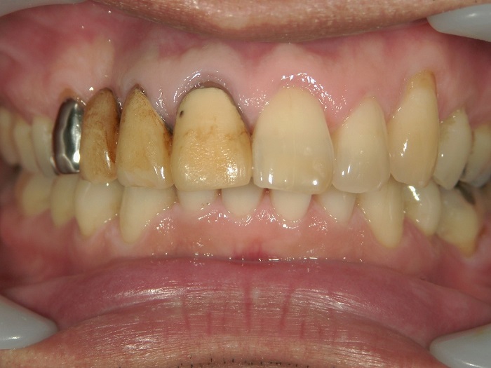 before Case of Whitening Silver crown and Discolored Teeth