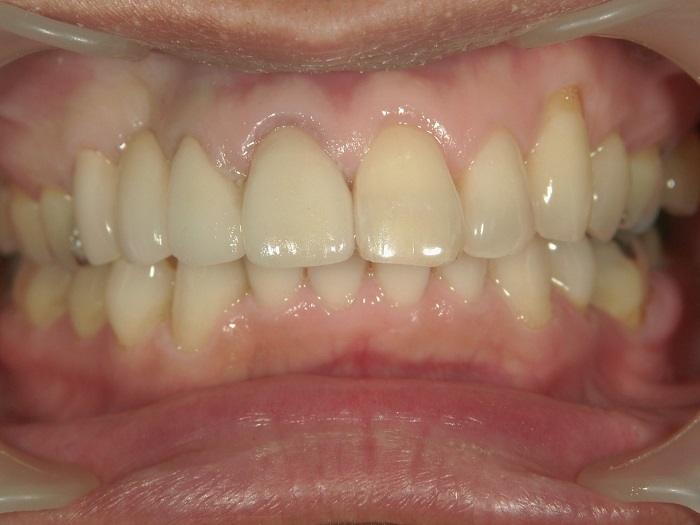 after Case of Whitening Silver crown and Discolored Teeth