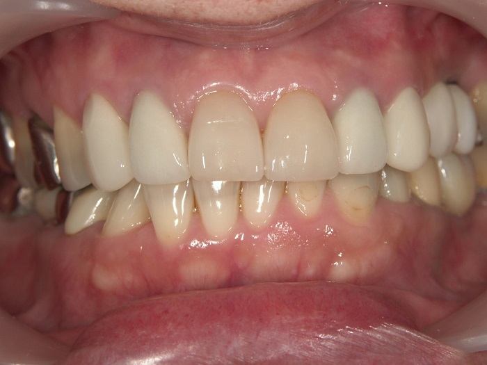 before Case of replacing silver crowns and whitening the entire front teeth