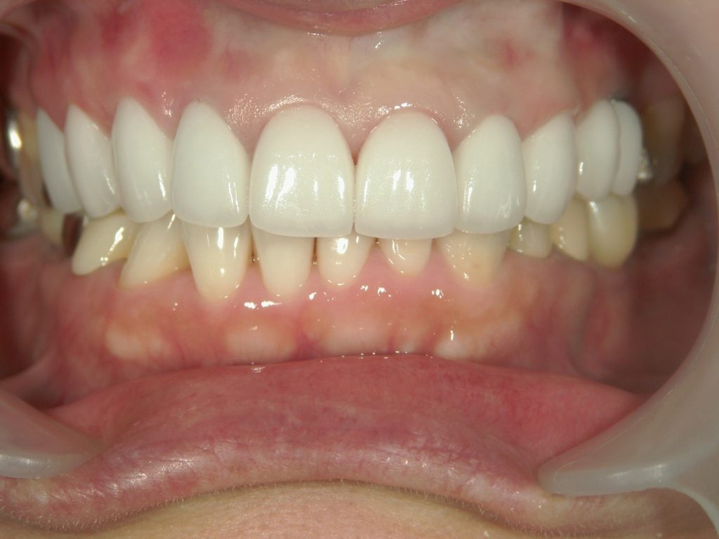 after Case of replacing silver crowns and whitening the entire front teeth
