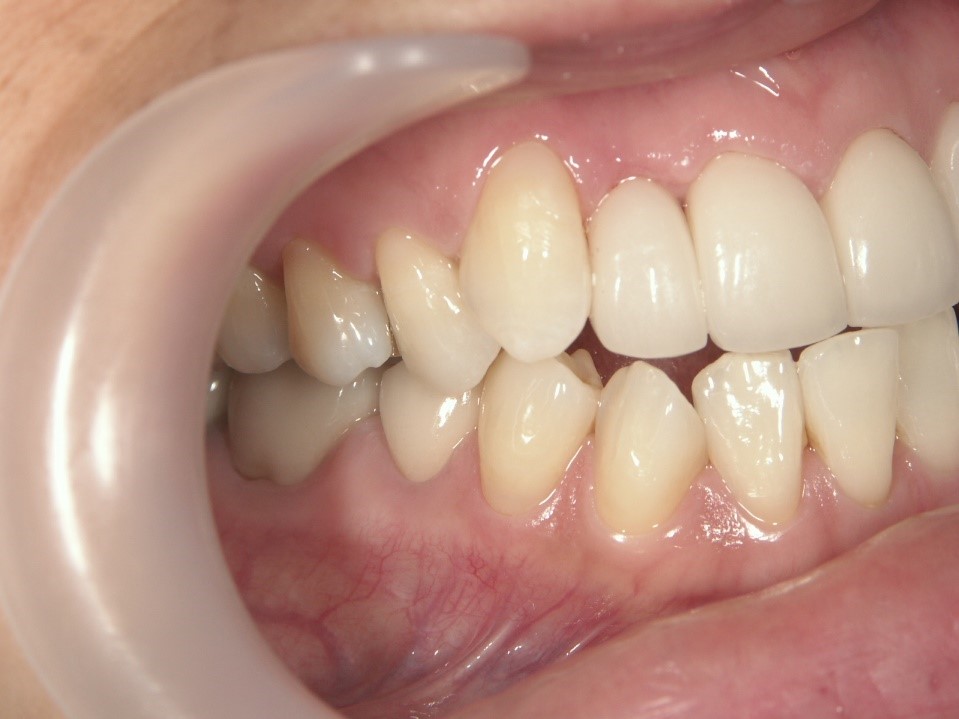 After Case Photos of Crowded (crooked) Teeth Treatment