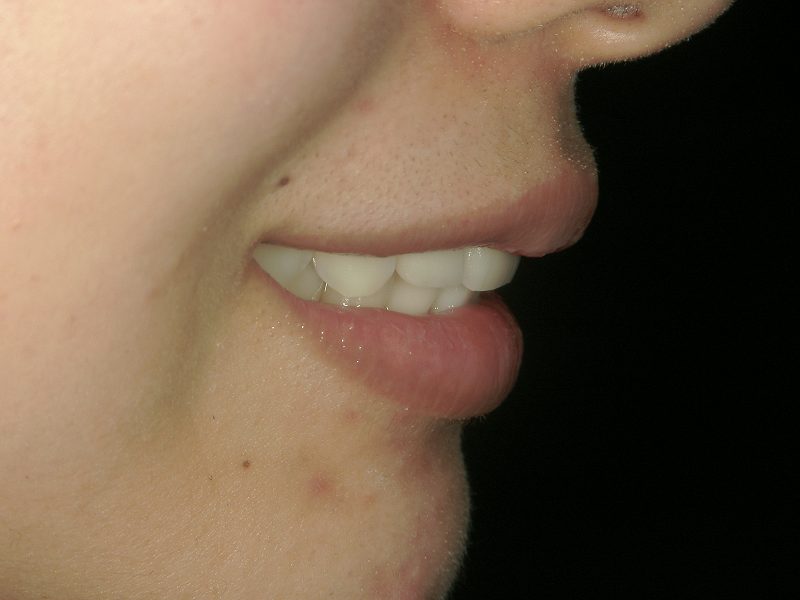 After Protruding Teeth (or Buck Teeth) Treatment