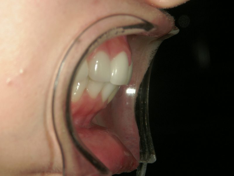 After Protruding Teeth (or Buck Teeth) Treatment