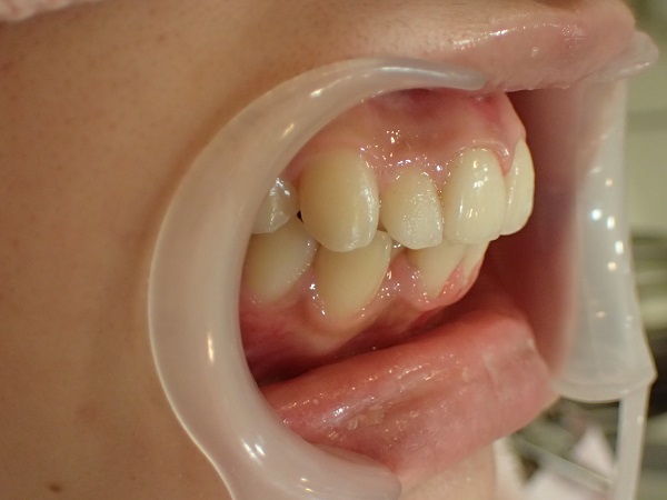 After Protruding Teeth (or Buck Teeth) Treatment