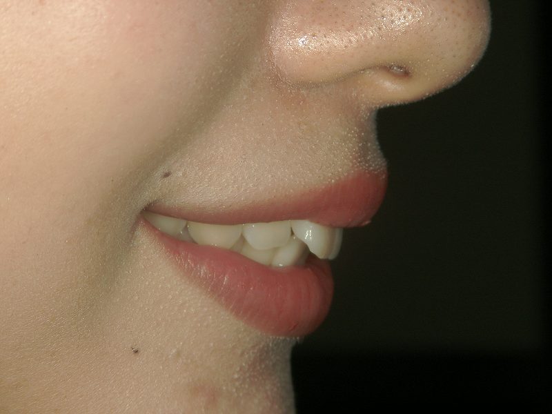 Before Protruding Teeth (or Buck Teeth) Treatment