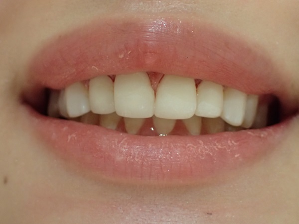Adjustment of Temporary Teeth