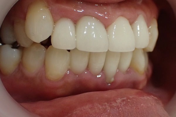 After Case Photos of Crowded (crooked) Teeth Treatment