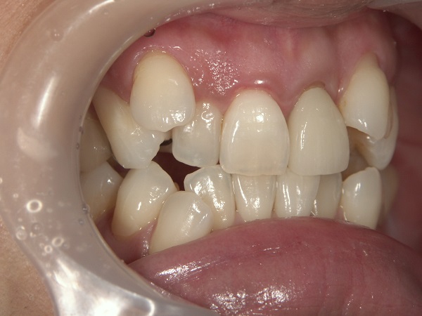 Before Case Photos of Crowded (crooked) Teeth Treatment