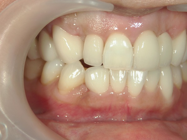 After Case Photos of Crowded (crooked) Teeth Treatment