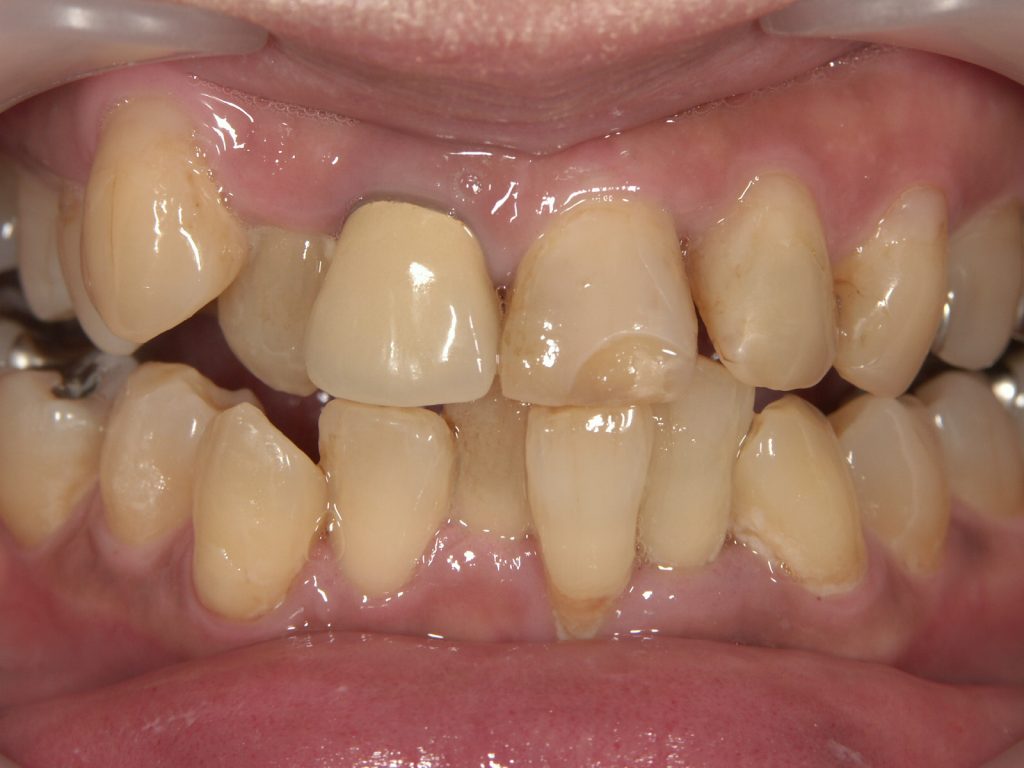 Before Case Photos of Crowded (crooked) Teeth Treatment