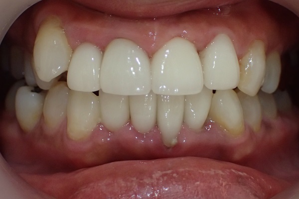 After Case Photos of Crowded (crooked) Teeth Treatment