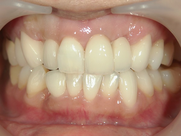 After Case Photos of Crowded (crooked) Teeth Treatment