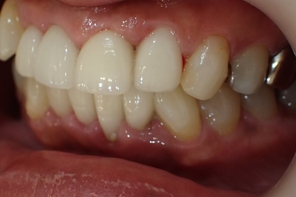 After Case Photos of Crowded (crooked) Teeth Treatment