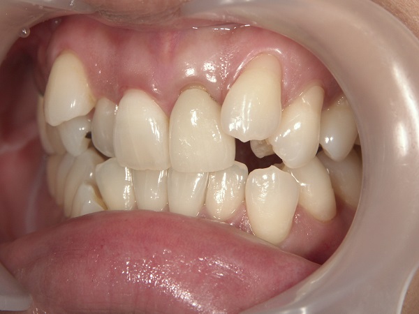 Before Case Photos of Crowded (crooked) Teeth Treatment