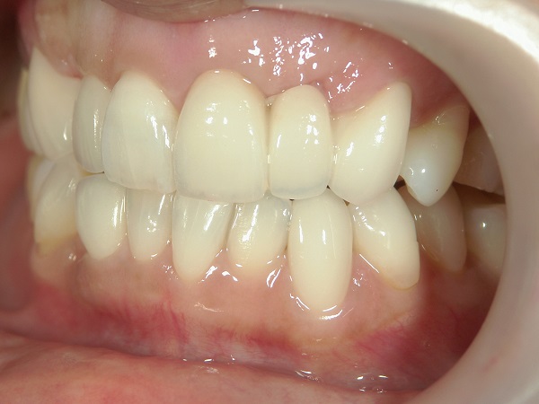 After Case Photos of Crowded (crooked) Teeth Treatment