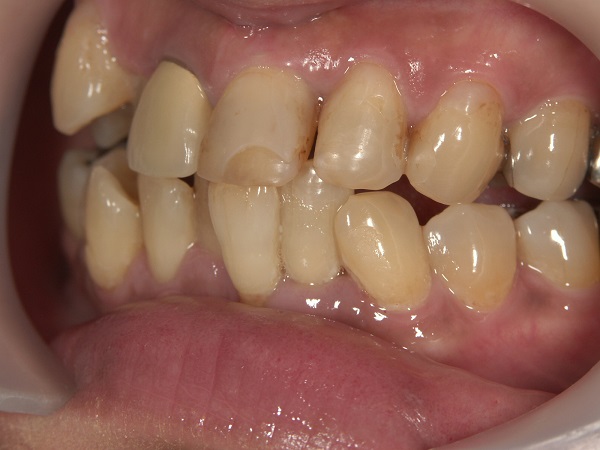 Before Case Photos of Crowded (crooked) Teeth Treatment