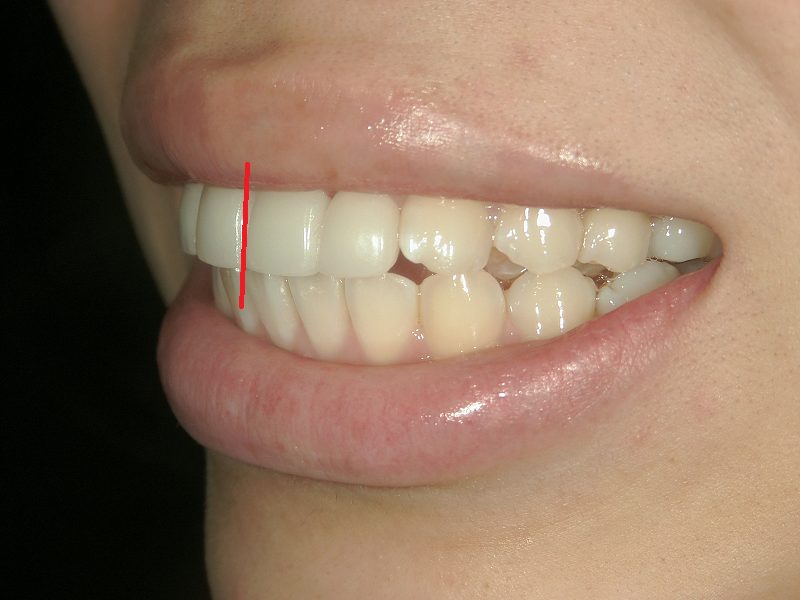 利用全瓷牙冠改善深覆合的案例治疗后