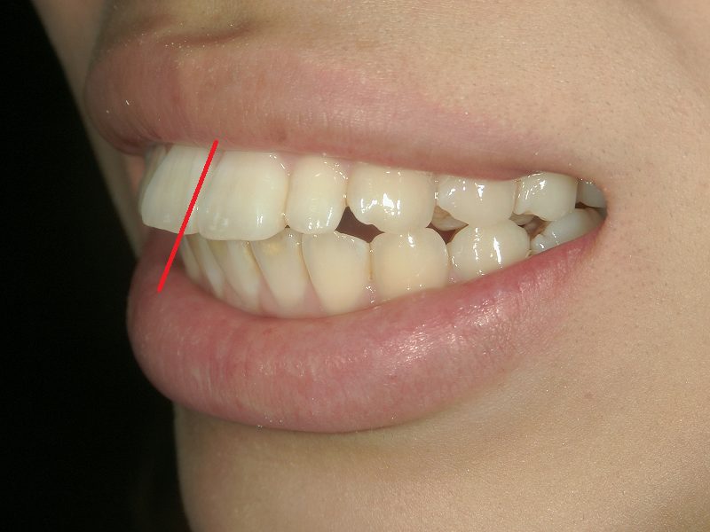 利用全瓷牙冠改善深覆合的案例治疗前
