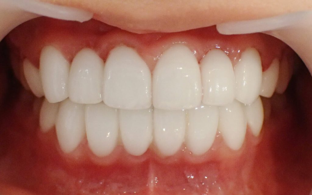Ceramic Crowns for the Front 16 (Upper and Lower) Teeth