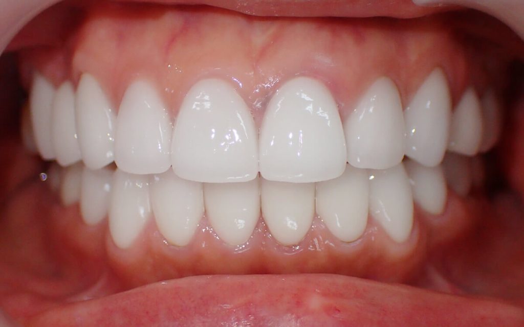 Ceramic Crowns for the Front 20 (Upper and Lower) Teeth