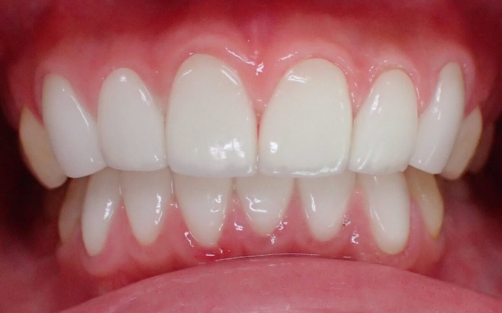 Ceramic Crowns for the Front 12 (Upper and Lower) Teeth​