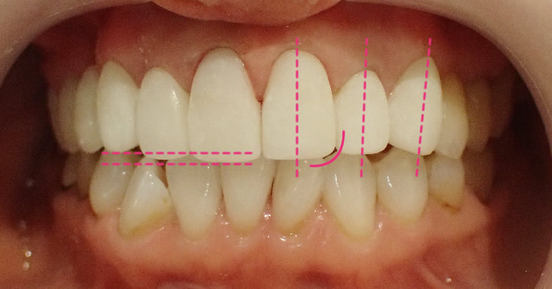 Adjustment of the Temporary Tooth