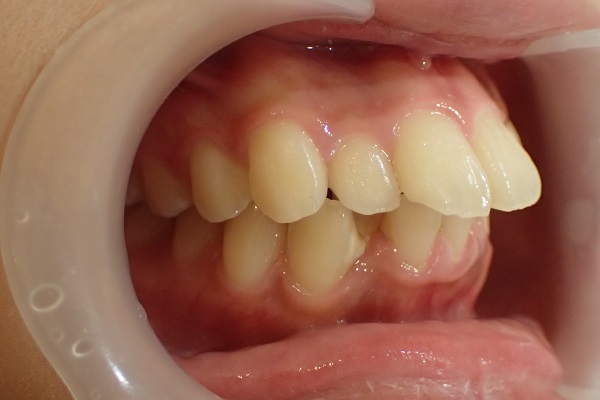 龅牙是一种无关人种的常见牙颌畸形